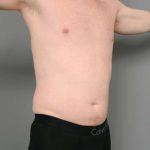 Liposuction Before & After Patient #618
