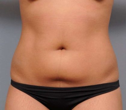 Liposuction Before & After Patient #635