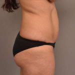 Tummy Tuck Before & After Patient #260