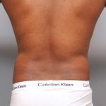 Liposuction Before & After Patient #648
