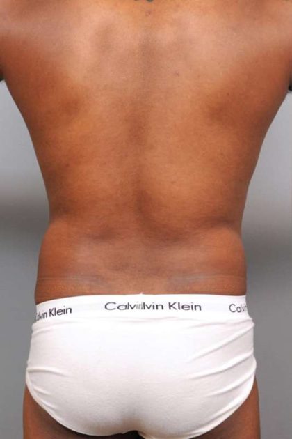 Liposuction Before & After Patient #648