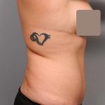 Liposuction Before & After Patient #662
