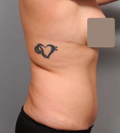 Liposuction Before & After Patient #662