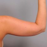 Liposuction Before & After Patient #669