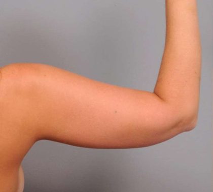 Liposuction Before & After Patient #669