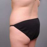 Liposuction Before & After Patient #681