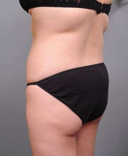 Liposuction Before & After Patient #681