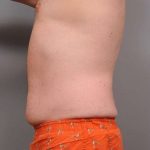 Liposuction Before & After Patient #688