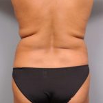 Liposuction Before & After Patient #695
