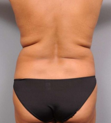 Liposuction Before & After Patient #695