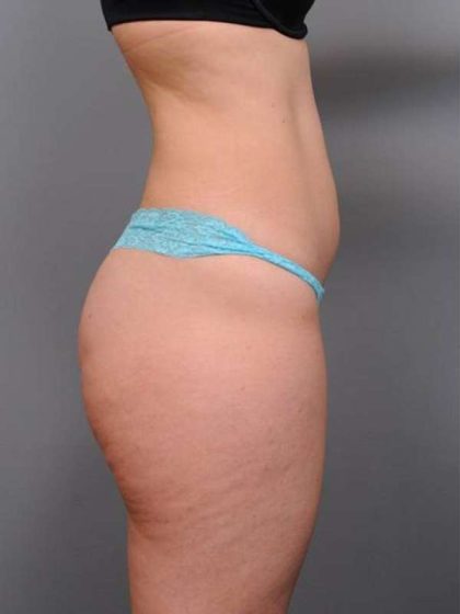 Liposuction Before & After Patient #716
