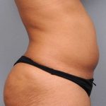 Liposuction Before & After Patient #738