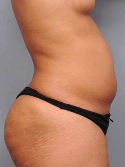 Liposuction Before & After Patient #738