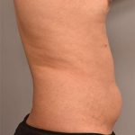Liposuction Before & After Patient #749