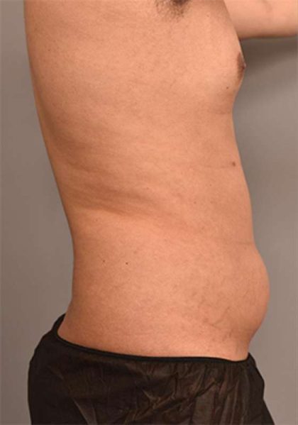 Liposuction Before & After Patient #749