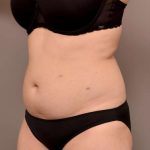 Liposuction Before & After Patient #756