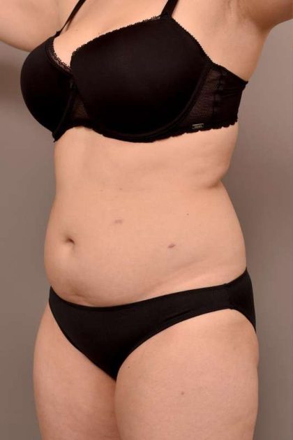 Liposuction Before & After Patient #756