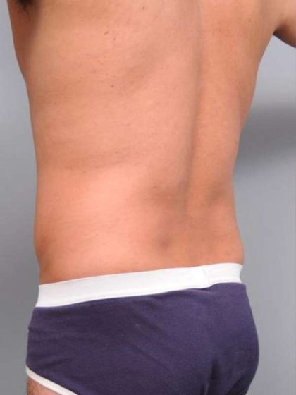 Liposuction Before & After Patient #783