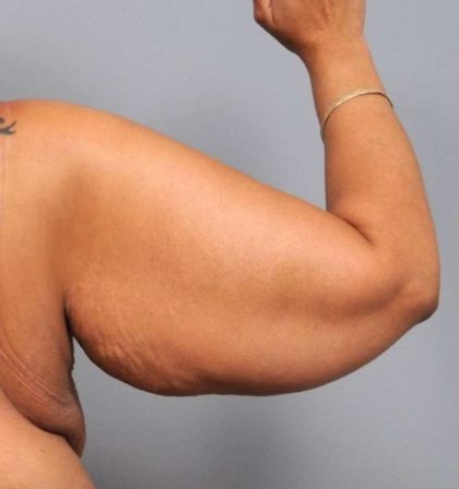 Arm Lift Before & After Patient #790