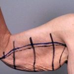 Arm Lift Before & After Patient #807