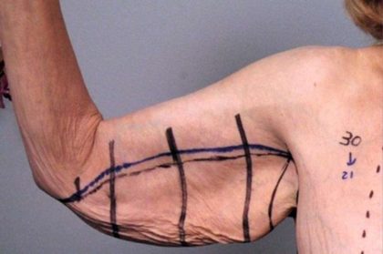 Arm Lift Before & After Patient #807