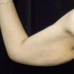 Arm Lift Before & After Patient #814