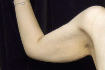 Arm Lift Before & After Patient #814