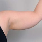 Arm Liposuction Before & After Patient #826