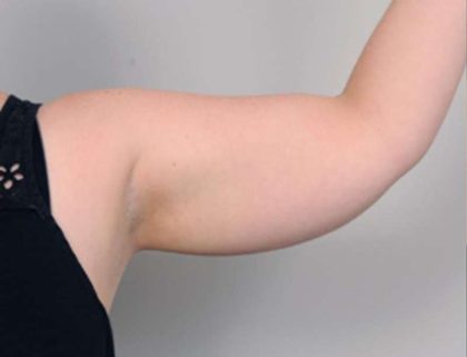 Arm Liposuction Before & After Patient #826