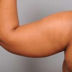 Arm Liposuction Before & After Patient #833