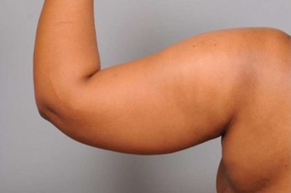 Arm Liposuction Before & After Patient #833