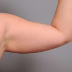 Arm Liposuction Before & After Patient #842