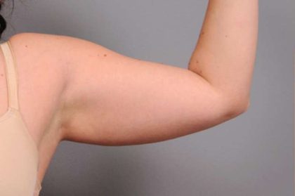 Arm Liposuction Before & After Patient #842