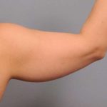 Arm Liposuction Before & After Patient #851