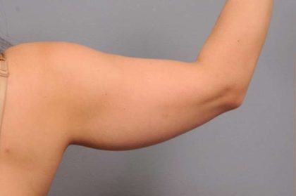 Arm Liposuction Before & After Patient #851