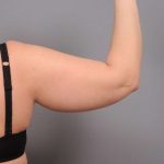 Arm Liposuction Before & After Patient #872