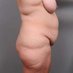 Lower Body Lift Before & After Patient #916
