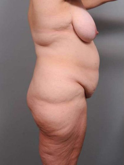 Lower Body Lift Before & After Patient #916