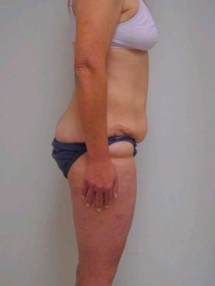 Lower Body Lift Before & After Patient #925