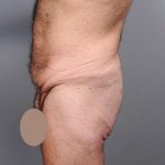 Lower Body Lift Before & After Patient #932