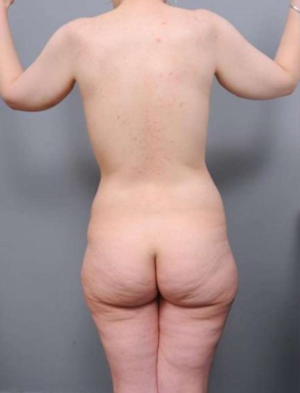 Lower Body Lift Before & After Patient #941
