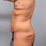 Lower Body Lift Before & After Patient #952