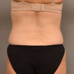 Tummy Tuck Before & After Patient #287