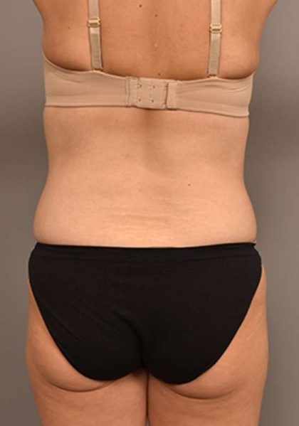 Tummy Tuck Before & After Patient #287