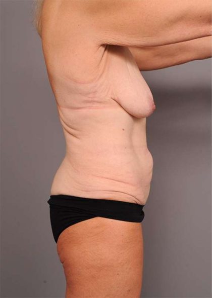 Lower Body Lift Before & After Patient #974