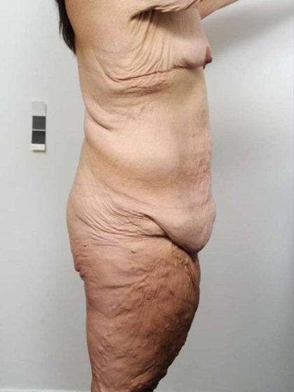 Lower Body Lift Before & After Patient #985