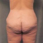 Lower Body Lift Before & After Patient #992