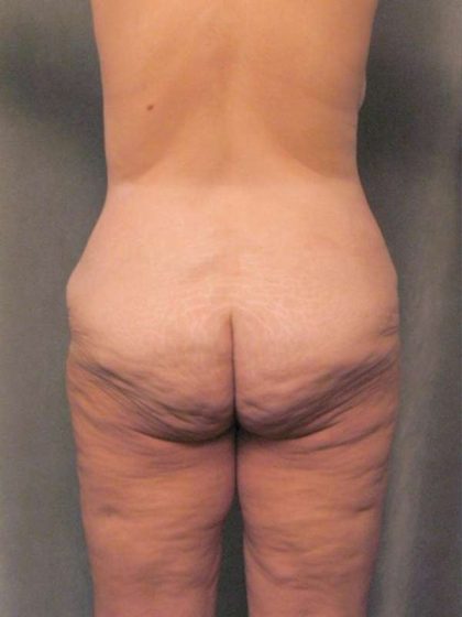Lower Body Lift Before & After Patient #992