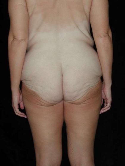 Lower Body Lift Before & After Patient #999
