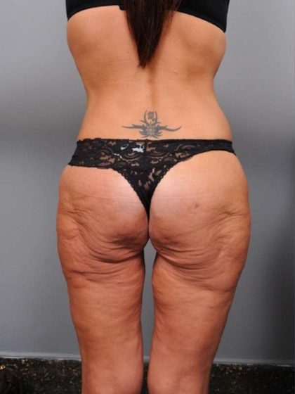 Lower Body Lift Before & After Patient #1010